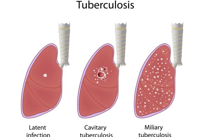 5 olahraga yang tepat untuk tuberkulosis