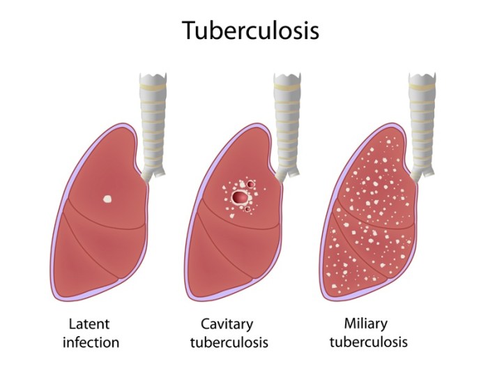 5 olahraga yang tepat untuk tuberkulosis