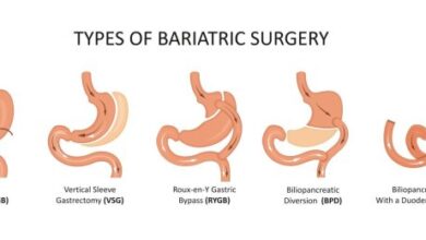 5 fakta penting mengenai operasi bariatrik yang perlu diketahui
