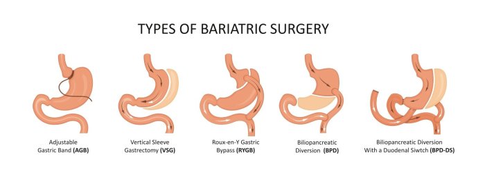 5 fakta penting mengenai operasi bariatrik yang perlu diketahui