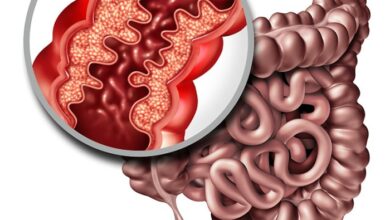 5 faktor risiko crohns disease yang perlu diwaspadai