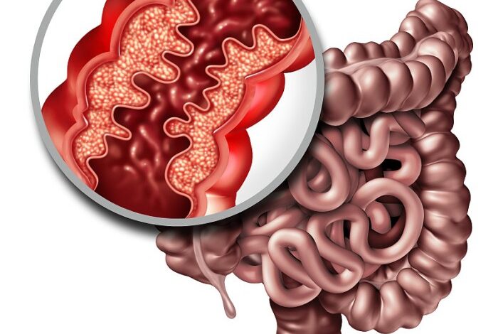 5 faktor risiko crohns disease yang perlu diwaspadai