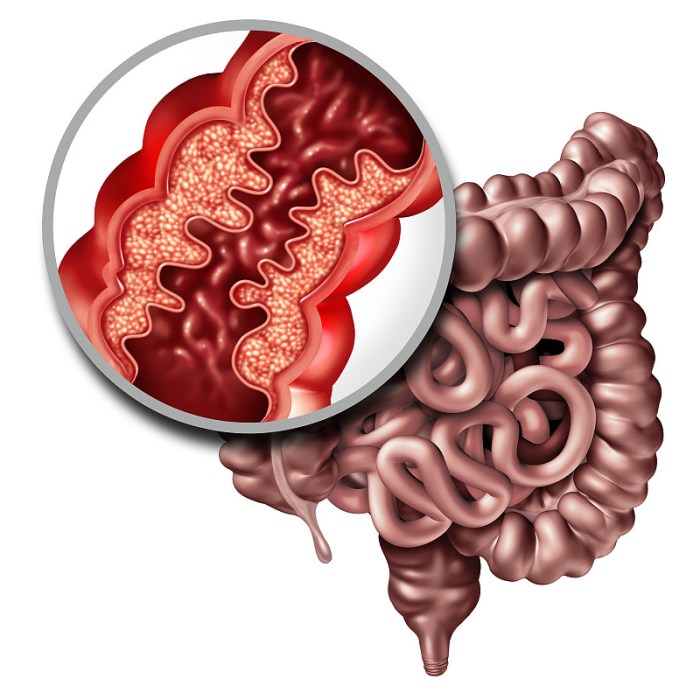 5 faktor risiko crohns disease yang perlu diwaspadai