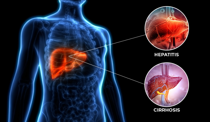 2 perbedaan hepatitis dan sirosis hati