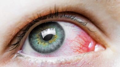 5 penyebab bercak merah pada mata