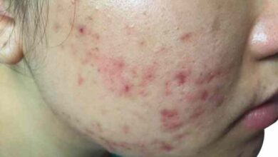 5 masalah kulit wajah yang bisa diatasi dengan peeling wajah