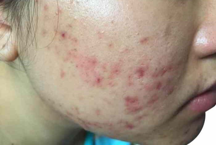 5 masalah kulit wajah yang bisa diatasi dengan peeling wajah