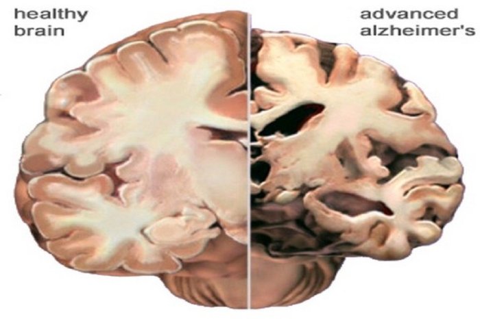 5 faktor penyebab alzheimer pada seseorang