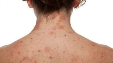 5 penyakit kulit yang bisa diatasi dengan garamycin