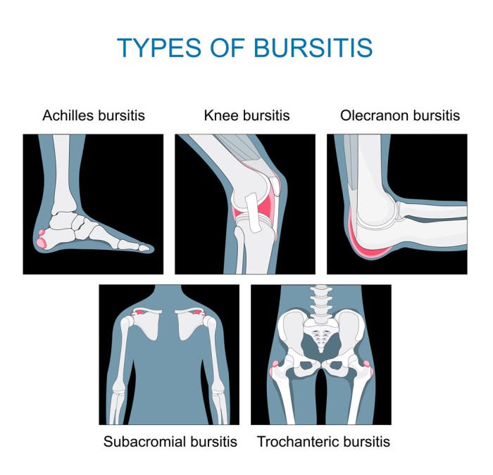 3 bagian tubuh tempat terjadi bursitis