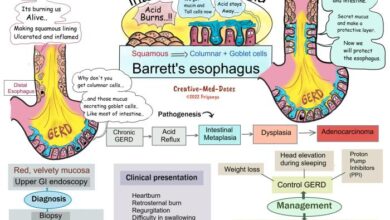 5 faktor penyebab barrett s esophagus yang perlu dipahami 1