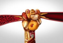 5 prosedur untuk mendiagnosis arteriosklerosis