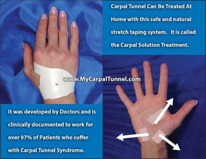 5 cara mengobati carpal tunnel syndrome tanpa operasi