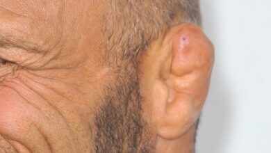 5 fakta mengenai cauliflower ear telinga menyerupai kembang kol