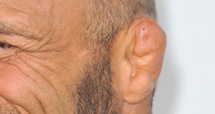 5 fakta mengenai cauliflower ear telinga menyerupai kembang kol