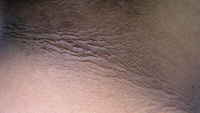 5 penyebab akantosis nigrikans yang perlu diketahui