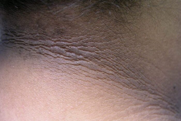 5 penyebab akantosis nigrikans yang perlu diketahui