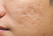 5 rekomendasi krim penghilang bekas jerawat yang membandel