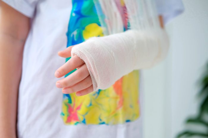 5 cara merawat gips saat alami patah tulang