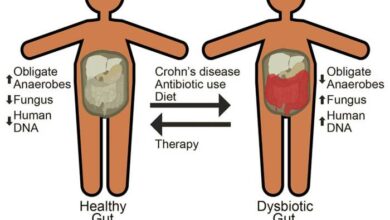 5 komplikasi crohns disease yang perlu diwasapadai