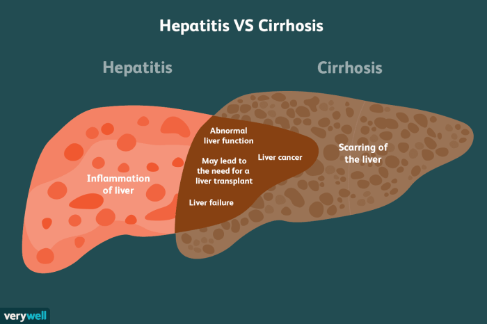 2 perbedaan hepatitis dan sirosis hati