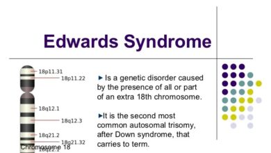 2 diagnosis sindrom edward setelah melahirkan