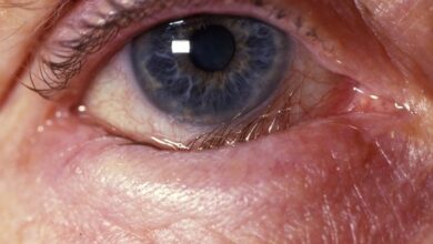 5 pilihan pengobatan entropion penyebab kelopak mata masuk ke dalam