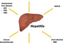 2 cara atasi radang hati akibat hepatitis d