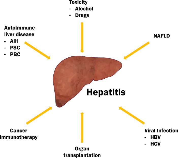 2 cara atasi radang hati akibat hepatitis d