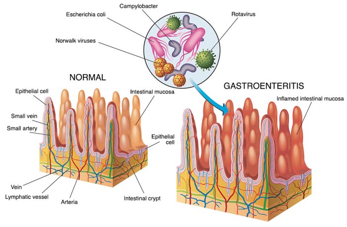 2 cara penularan gastroenteritis