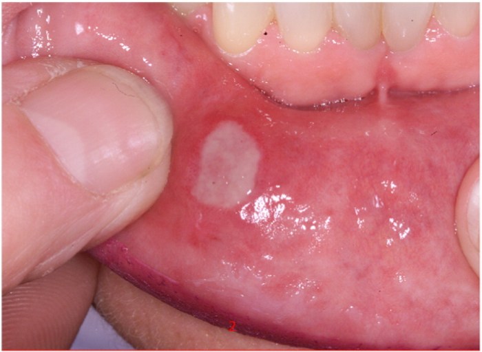 5 mitos tentang stomatitis yang belum tentu benar