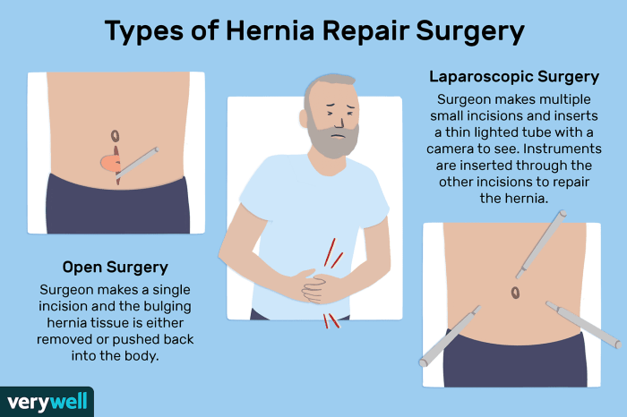 5 jenis hernia penyakit yang dikenal sebagai turun berok