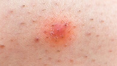 5 penyebab rambut tumbuh ke dalam