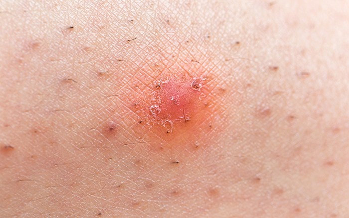 5 penyebab rambut tumbuh ke dalam