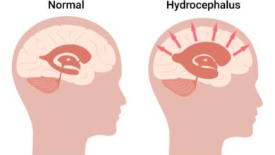 2 gejala awal saat bayi mengalami hidrosefalus