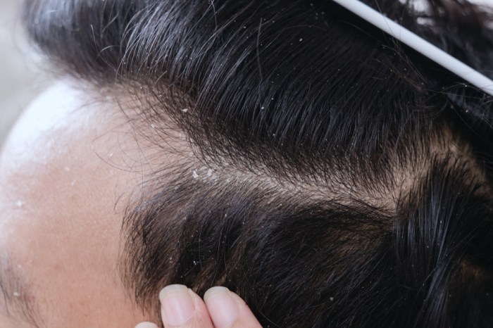 5 penyebab munculnya ketombe