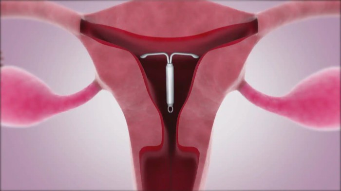 5 fakta tentang kontrasepsi iud yang perlu diketahui