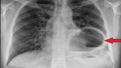 5 pemeriksaan penunjang untuk diagnosis hernia diafragma