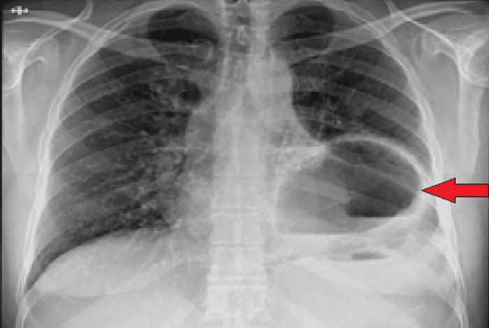 5 pemeriksaan penunjang untuk diagnosis hernia diafragma