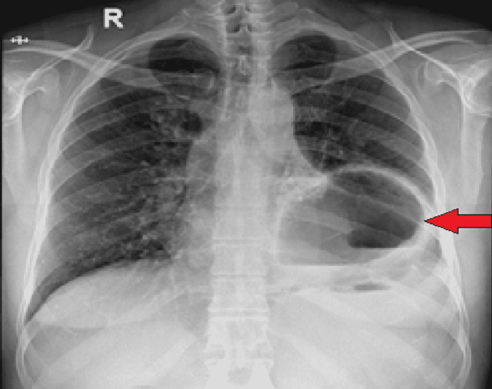 5 pemeriksaan penunjang untuk diagnosis hernia diafragma