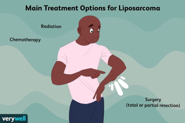 2 jenis terapi untuk atasi kondisi liposarcoma