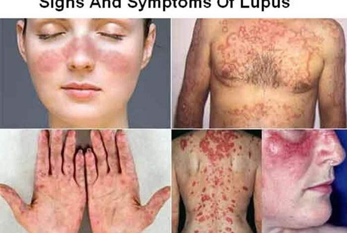 5 hal yang memicu kambuhnya gejala lupus nefritis