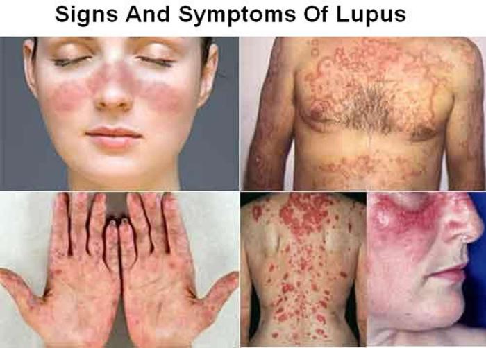 5 hal yang memicu kambuhnya gejala lupus nefritis