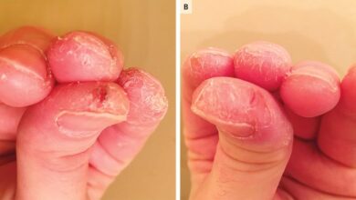 5 penyebab kulit tangan yang mudah mengelupas