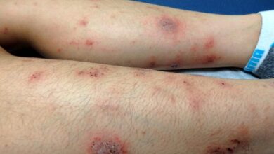 2 pemeriksaan untuk deteksi dermatitis numularis