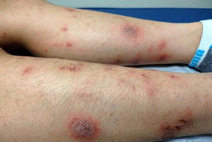 2 pemeriksaan untuk deteksi dermatitis numularis