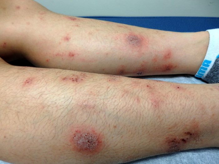 2 pemeriksaan untuk deteksi dermatitis numularis