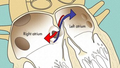 2 pengobatan patent foramen ovale yang dapat dilakukan