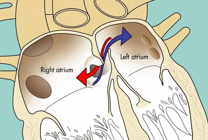 2 pengobatan patent foramen ovale yang dapat dilakukan