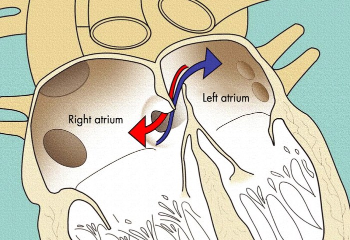 2 pengobatan patent foramen ovale yang dapat dilakukan